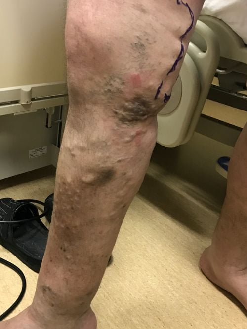 Varicose Veins Laser treatment