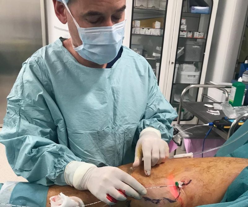Varicose Veins Laser treatment